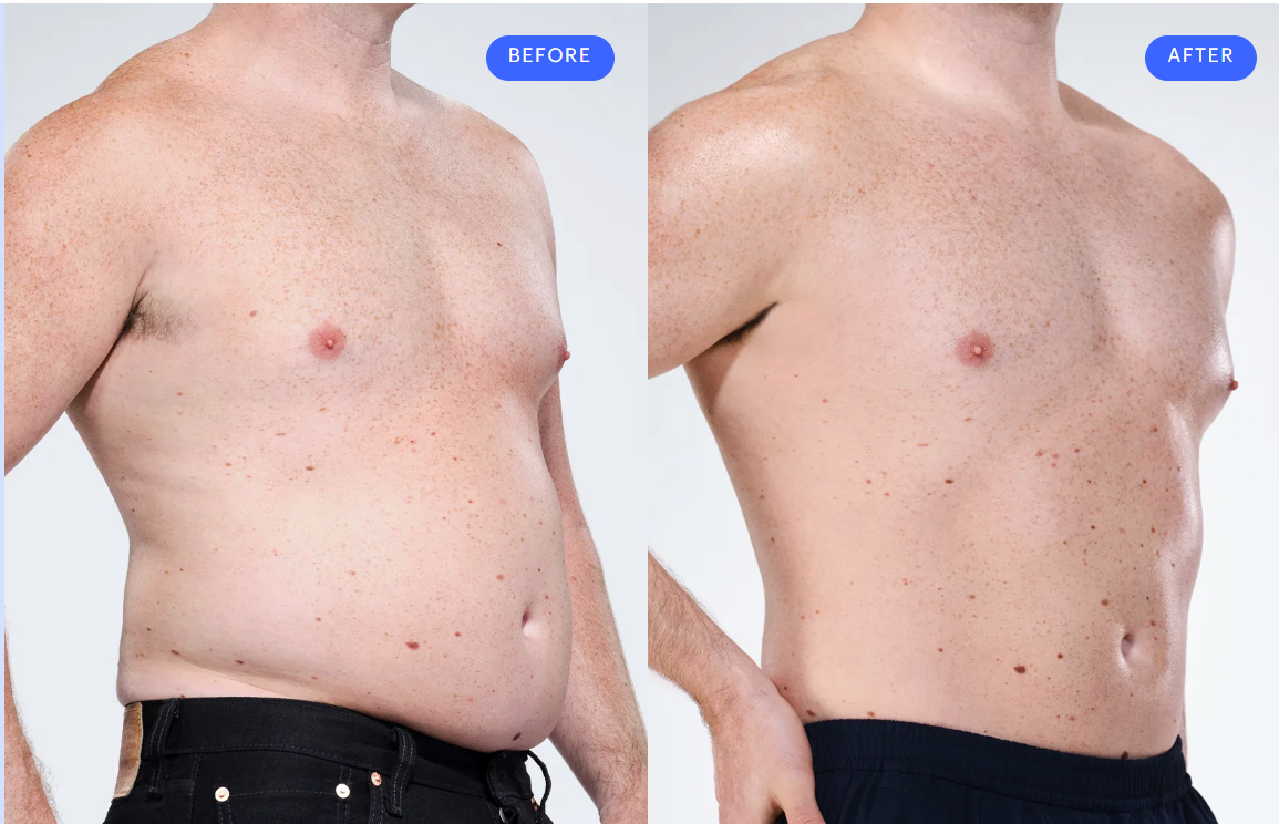 Abdomen CoolSculpting