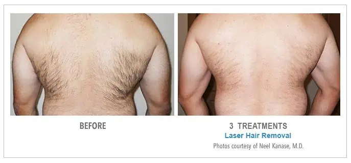 Back Laser Hair Removal Before and After