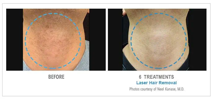 Neck Laser Hair Removal Before and After