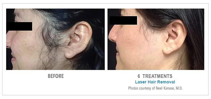 Sideburns Laser Hair Removal Before and After