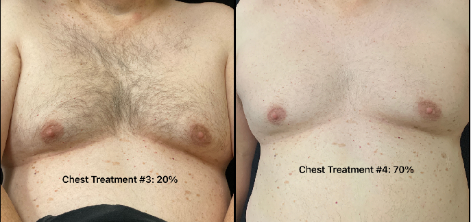 Chest Hair Removal