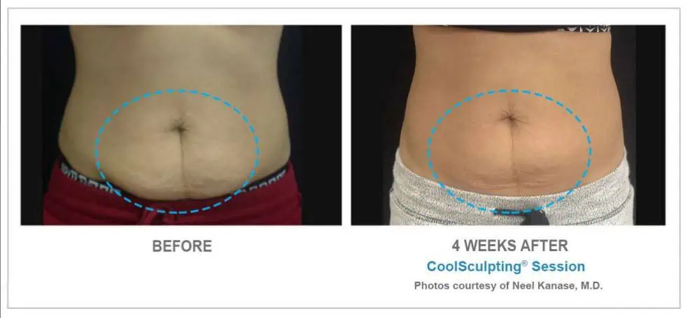 CoolSculpting Before and After Results 1