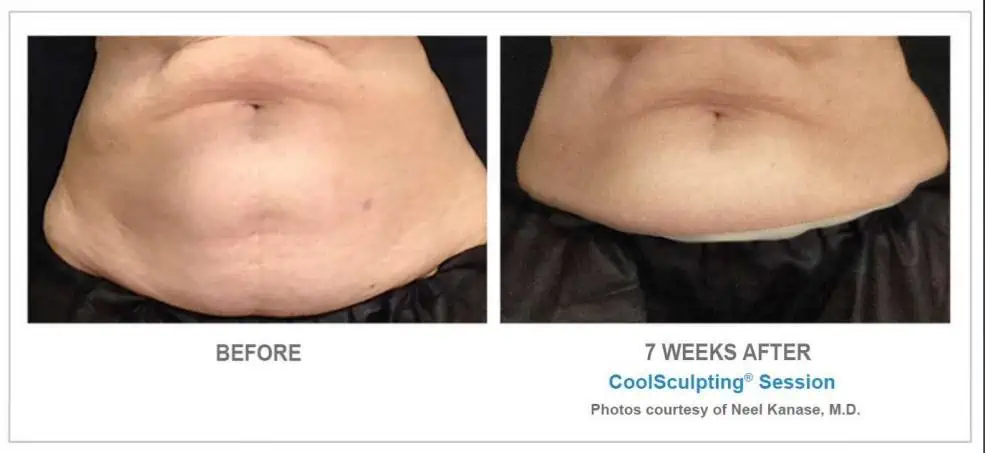 CoolSculpting Before and After Results 3