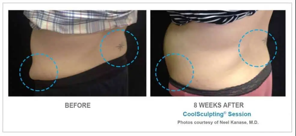 CoolSculpting Before and After Results 5
