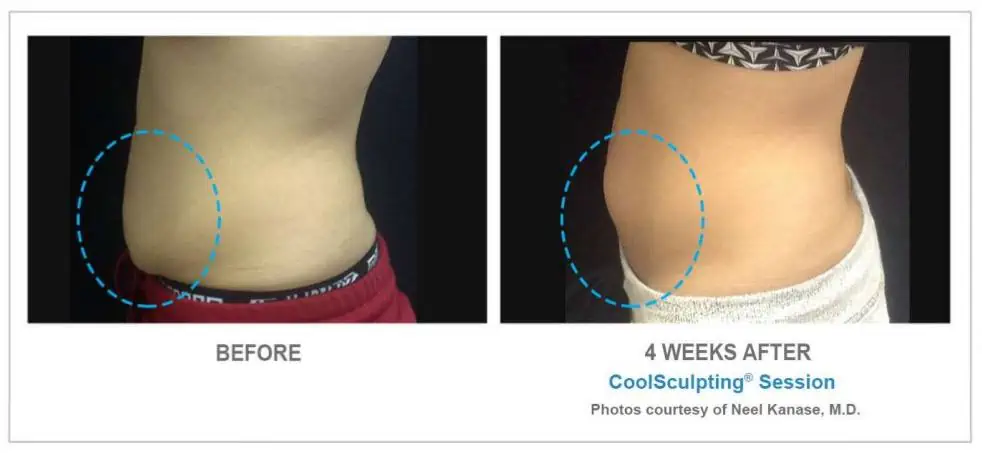 CoolSculpting Before and After Results 2