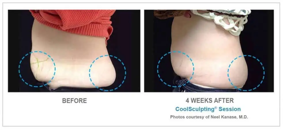 CoolSculpting Before and After Results 4
