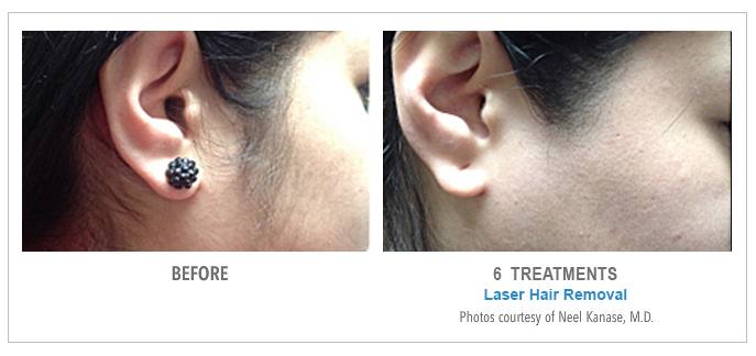 Laser Hair Removal Before & After Photos - Sideburns