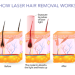 Laser Hair Removal