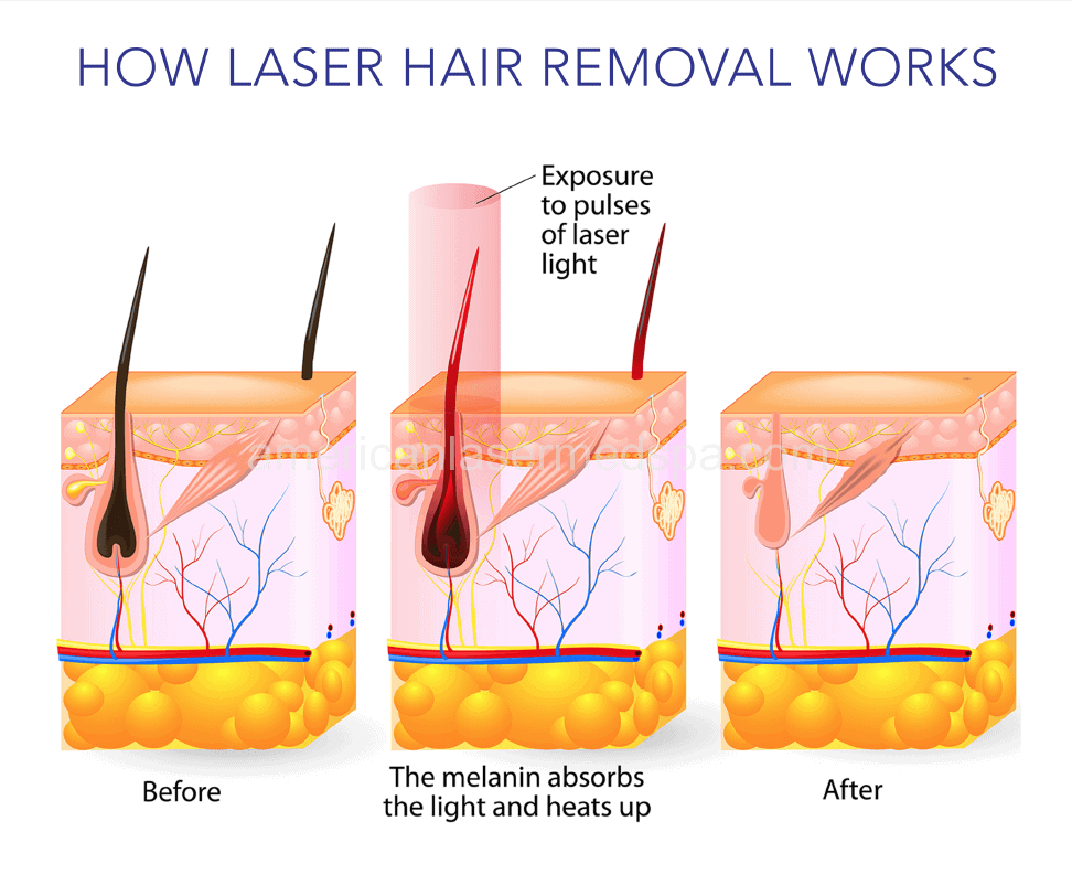 Laser Hair Removal