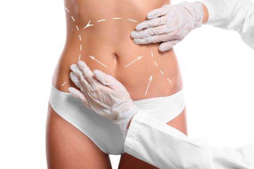 Decisions, Decisions: CoolSculpting® or Liposuction