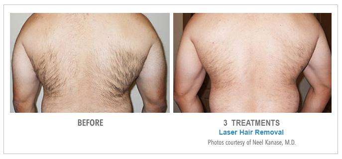 Laser Hair Removal Before & After Photos - Back