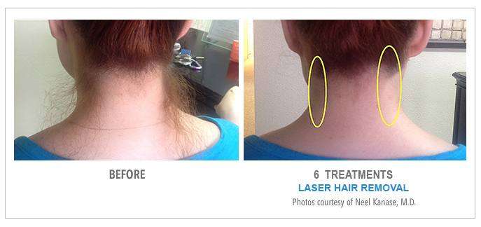 Laser Hair Removal Before & After Photos - Neck