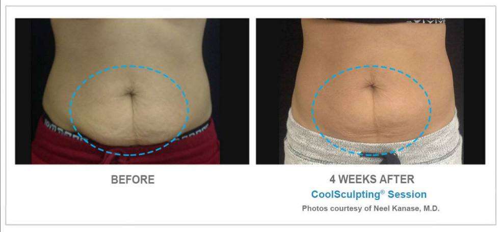 coolsculpting before after photos 2 102411