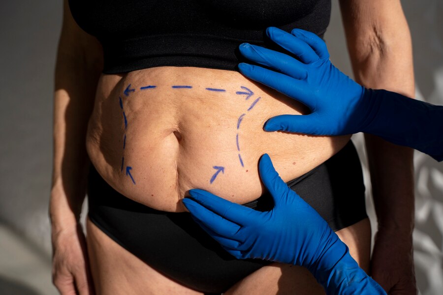 CoolSculpting and Liposuction