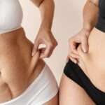 CoolSculpting vs. Liposuction (1)