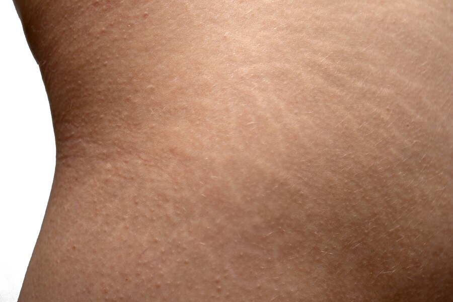 Microneedling For Stretch Marks