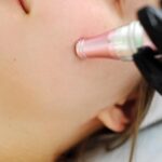 closeup-microneedling-treatment-skin_115318-10715