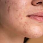 confident-young-woman-with-acne-close-up_23-2148982535