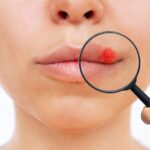 herpes-lip-young-woman-with-blisters-caused-by-virus-mouth-enlarged-with-magnifying_407348-2505