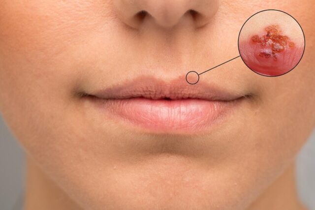 lip-bruises-caused-by-herpes-simplex-how-recognize-prevent-infection_651462-10