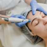 Microneedling And Confidence Boost