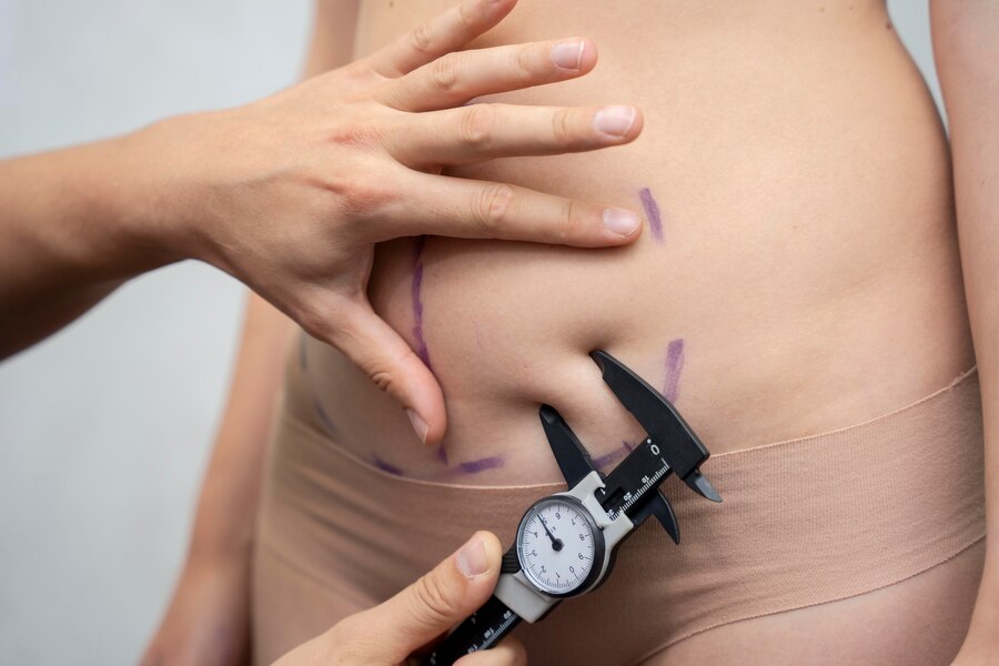 CoolSculpting Services