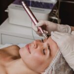 Microneedling Session