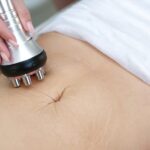 Microneedling for Stretch Marks