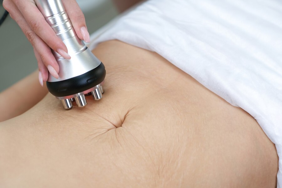 Microneedling for Stretch Marks