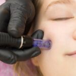 needle-mesotherapy-cosmetologist-performs-needle-mesotherapy-womans-face-beautiful-woman-receiving-microneedling-rejuvenation-treatment-needle-lifting_310443-518