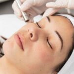 Microneedling for Hyperpigmentation