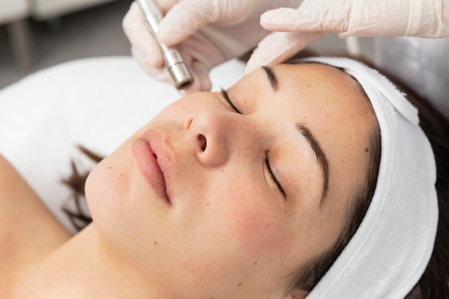 Microneedling for Hyperpigmentation