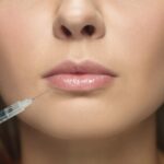 Juvederm for Lips