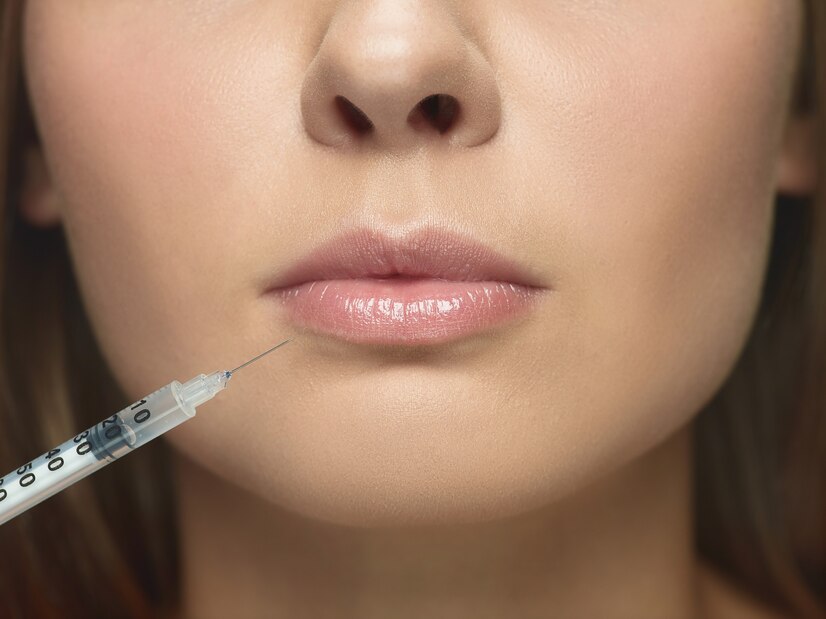 Juvederm for Lips