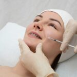 Acne Scar Microneedling