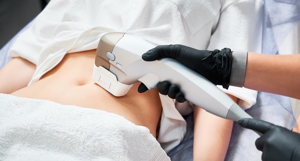 CoolSculpting