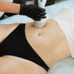 CoolSculpting Charges Midland