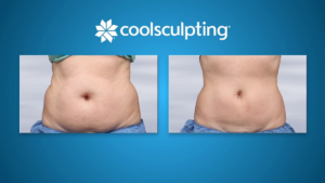 coolsculpting